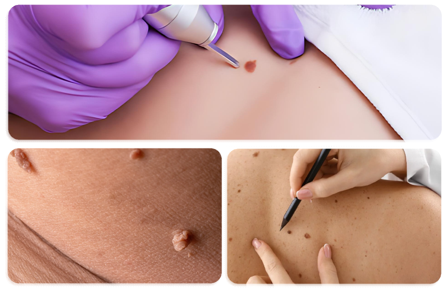 Skin Tags Removal